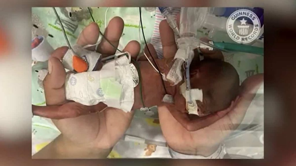 Born at 21 weeks, he became the world's youngest premature baby