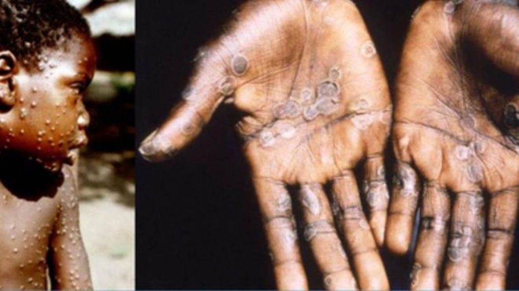 Deux nouveaux cas de "variole du singe" repérés au Royaume-Uni