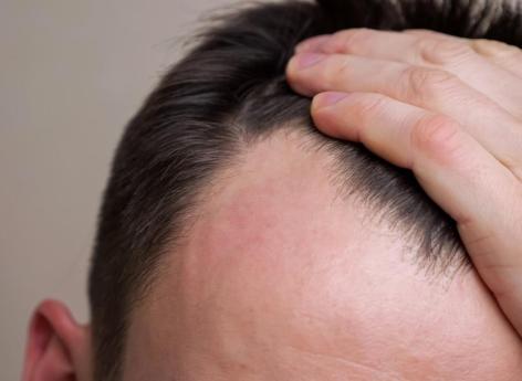 Protein can help fight baldness